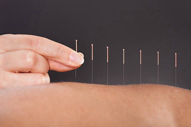 Acupuncture with a kick: Charged needles said to pump up results